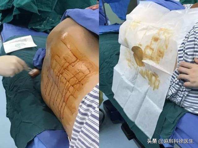 打麻醉是什么体验,半身麻醉多长时间恢复感觉