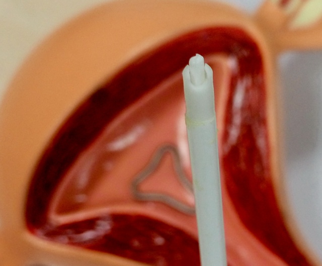 环节育器,避孕环和避孕器