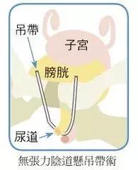 笑会流尿出来是什么原因,笑尿了正常吗健康科普