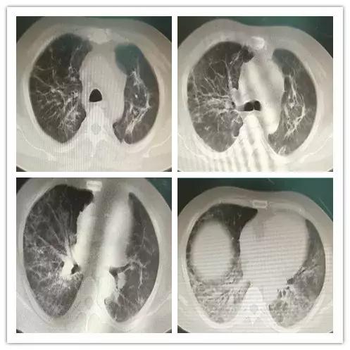 罕见病误诊的真实案例,误诊漏诊导致病人肿瘤癌变