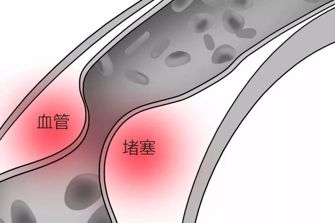 丙酸血症是怎么引起的啊,丙酸血症是什么意思