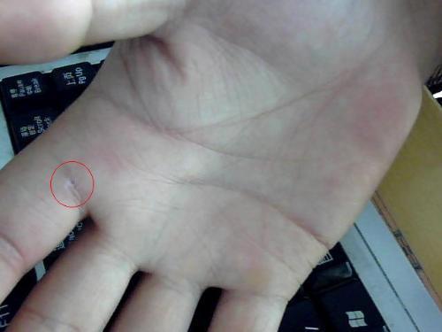 木刺扎到手指急救妙招,不小心把刺戳进手指里怎么办