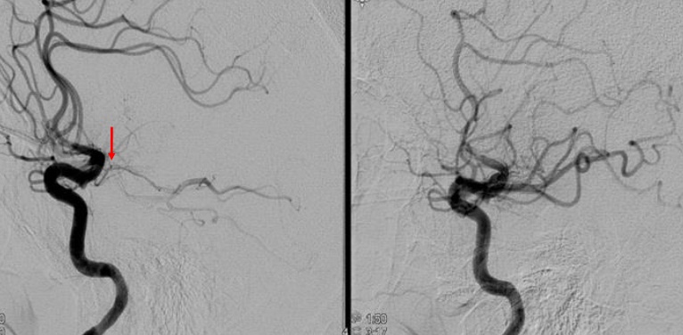 大脑动脉闭塞脑梗死怎么引起的,脑梗死的血管闭塞怎么治疗