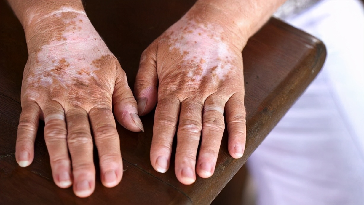 火疗引火烧身,引火归元针治疗三种病