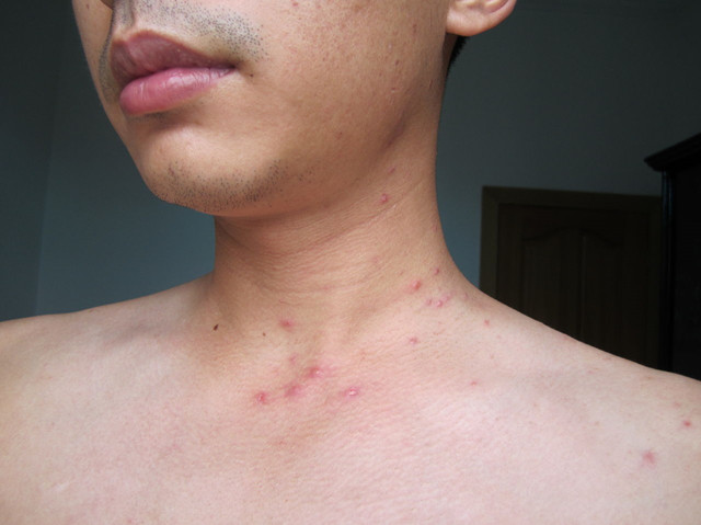 艾滋病出现皮肤变化就是艾滋病吗,艾滋病的早期表现别以为是皮肤病