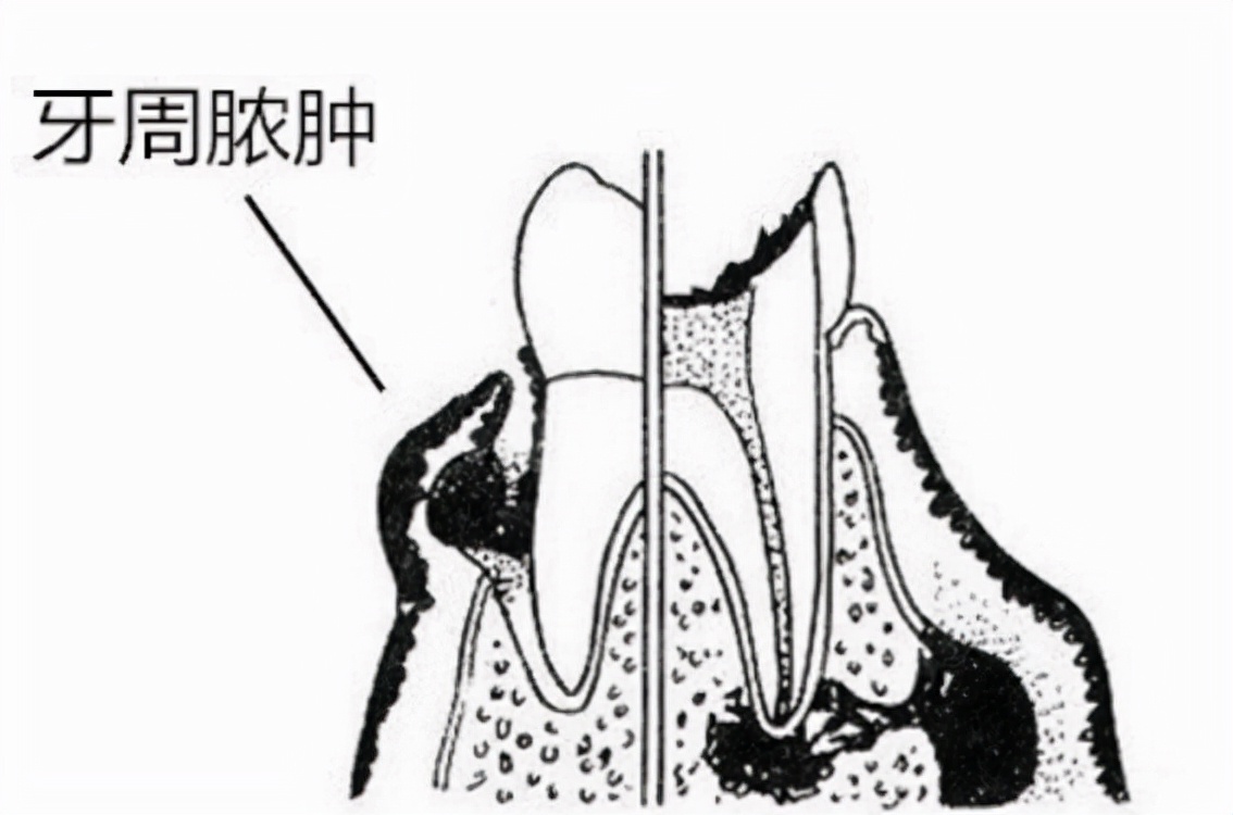 牙龈痛牙科怎么治疗,牙龈肿痛牙医擦的是什么药水