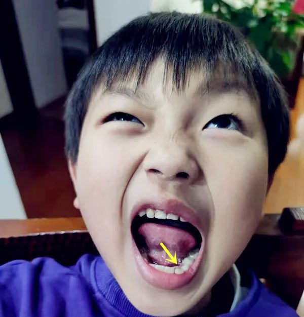 为什么乳牙好换牙就不好了,为什么现在的孩子换的门牙特别大