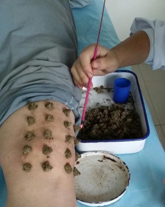 周楣声灸法理论,周楣声谈吹灸