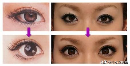 双眼皮后医生不建议用祛疤药,双眼皮手术后医生当场让看效果吗