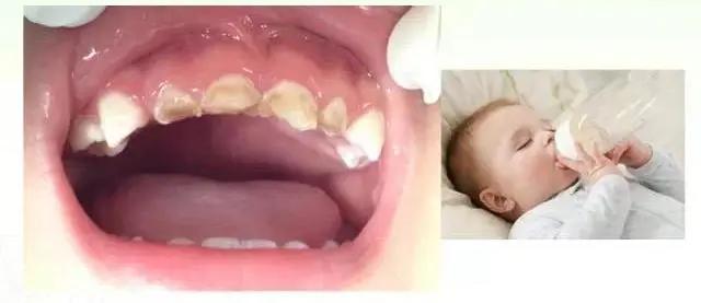 拒绝蛀牙幼儿,儿童拒绝治牙怎么办