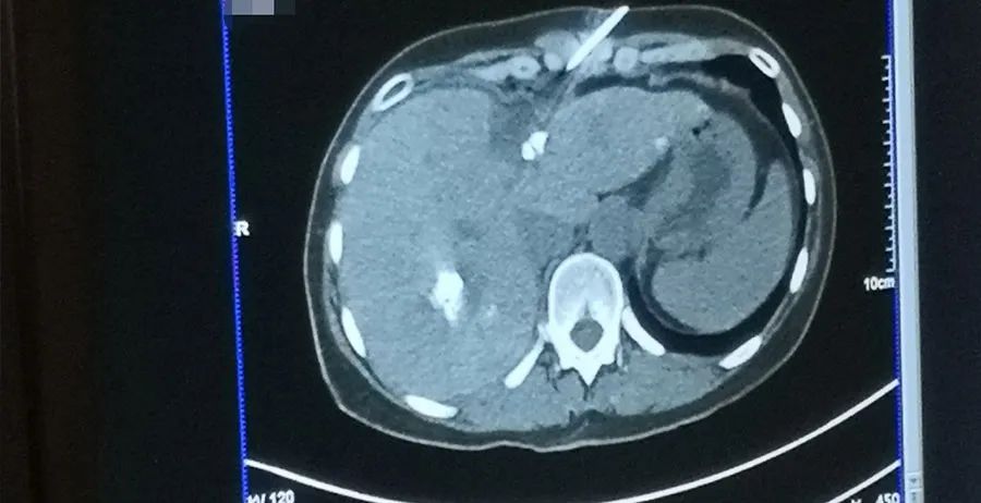 国际化进程|赛诺微精准消融，走进精工德国