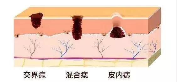 扁平疣和黑色素痣区别,疣与色素痣的区别