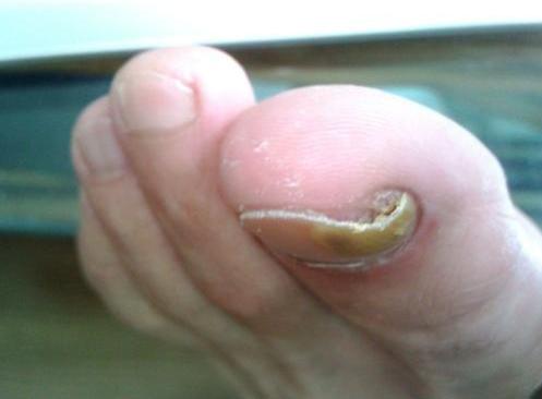 甲沟炎指甲陷肉里拔不出来怎么办,脚趾甲长进肉里怎么办小妙招