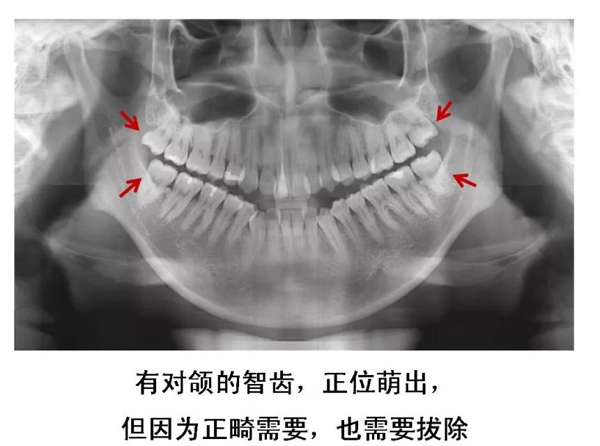 明星拔了智齿有垮脸的吗,明星拔完智齿