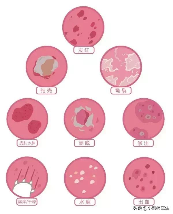 儿童湿疹的科普小知识,儿童湿疹科普视频