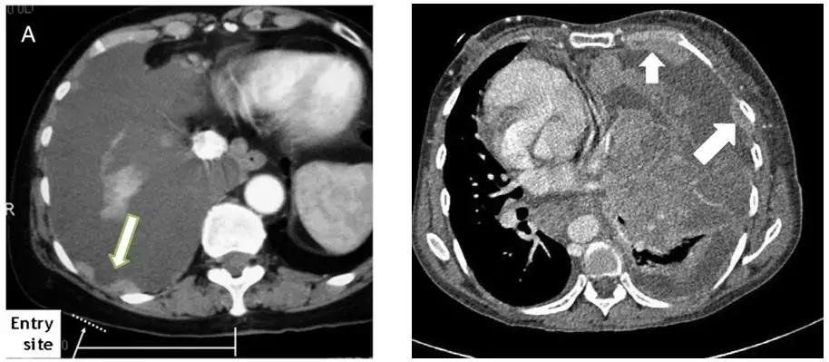 ct引导下穿刺活检诊断的分析,超声引导下穿刺活检什么样子的呢