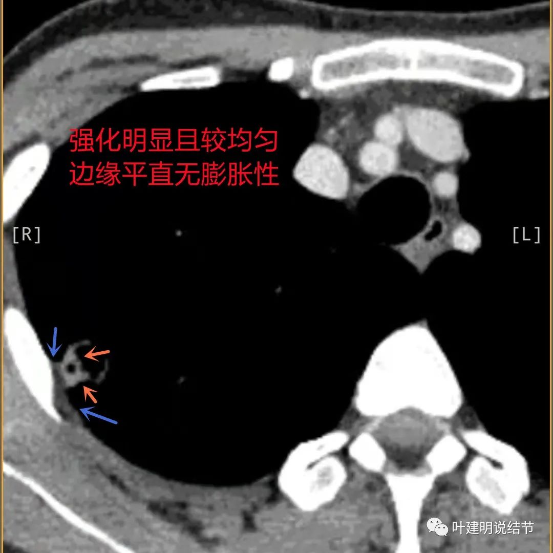 临床诊断孤立性肺结节,空洞型结节一般是什么性质