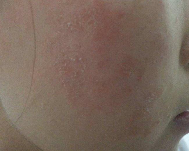 脸上发红发痒肿小妙招,脸上皮肤过敏红肿痒小妙招