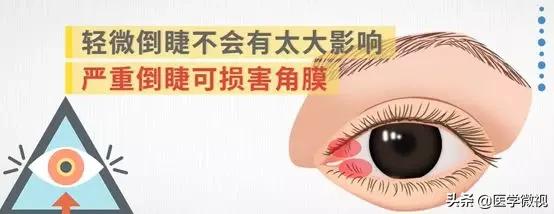 睫毛长倒睫怎么办,睫毛倒长扎眼睛怎么处理