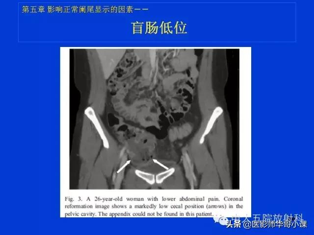 阑尾炎课件,阑尾炎的超声课件