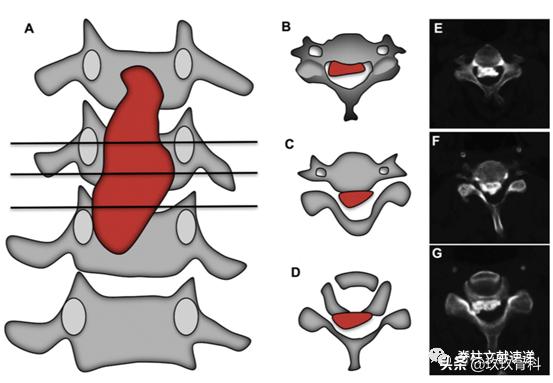 acaf手术适应脊髓型颈椎病吗,acaf术后康复方法