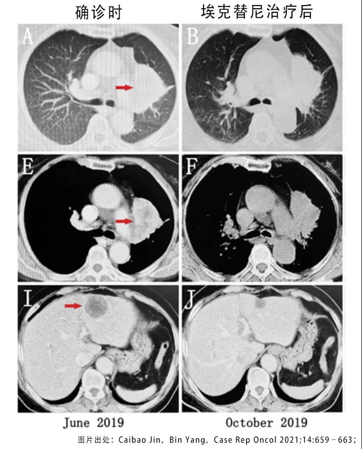 肺癌靶向药病灶减小癌胚抗原升高,肺癌吃靶向药病灶没了算治愈了吗