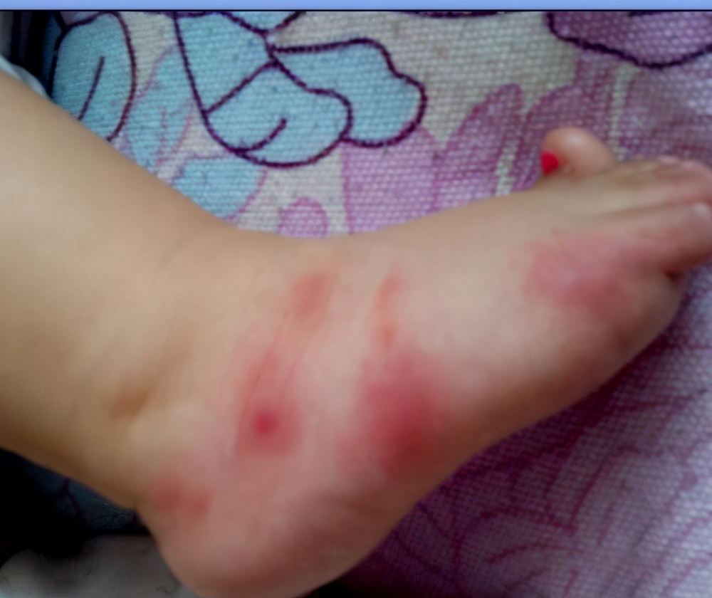 夏季避免宝宝蚊虫叮咬,夏天怎么预防蚊虫对宝宝的叮咬