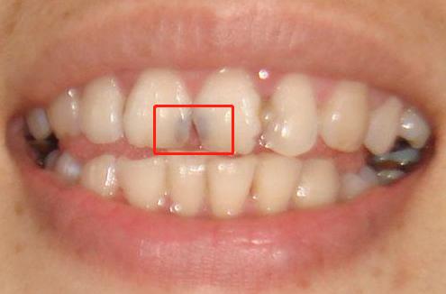 门牙外伤牙根发黑到底要怎么治疗,门牙牙缝中间黑了一点刷不掉