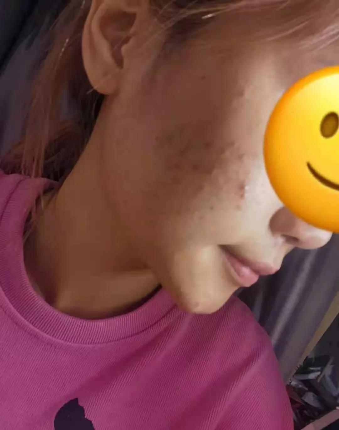 深圳治痘痘皮肤科哪个医院好啊,去皮肤科看痘痘好不好