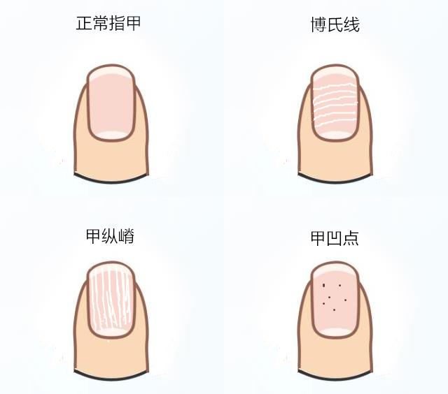 指甲哪些地方是有毛病,指甲的这些秘密你知道吗
