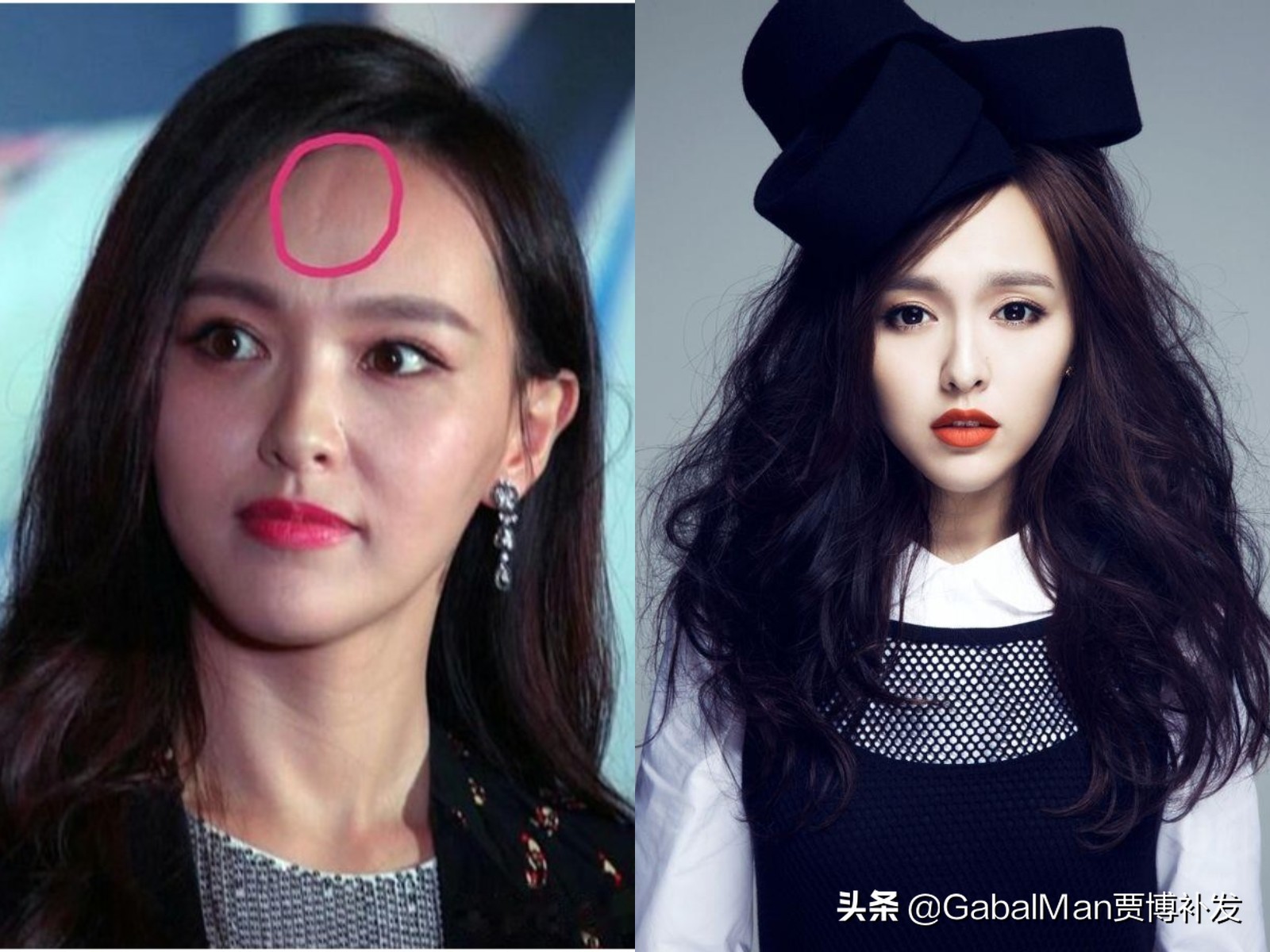 一招教你解决发际线高,发际线过高怎么拯救