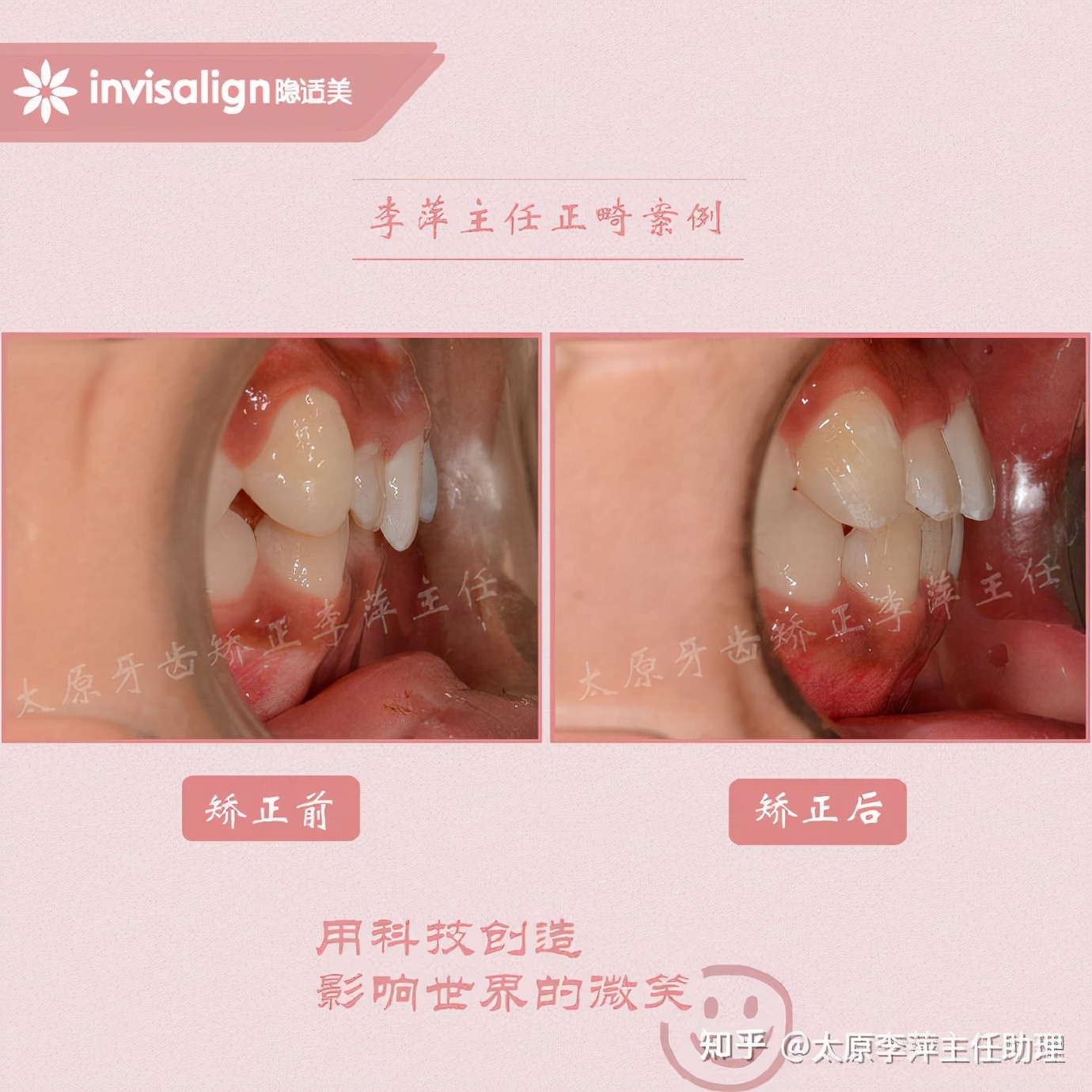 重度拥挤矫正牙齿适合隐形牙套吗,广州成人牙齿矫正推荐隐形牙套