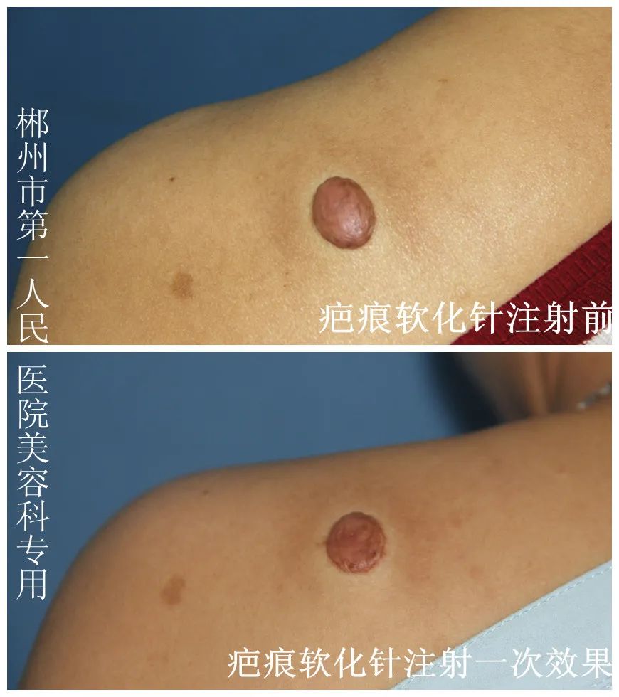 鼻子打疤痕软化针疼吗,打疤痕软化针注意事项