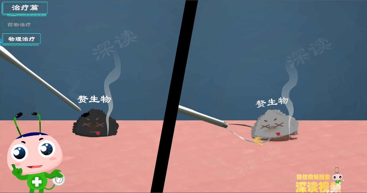 液氮冷冻治疗尖锐湿疣没感觉,液氮冷冻治疗尖锐湿疣注意事项