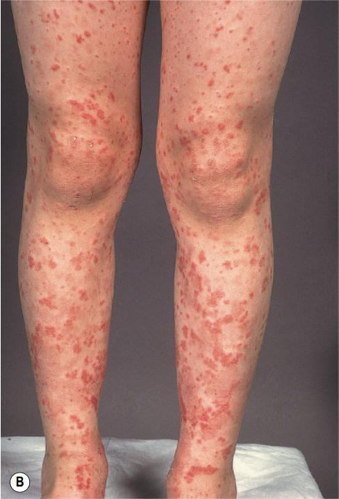 过敏性紫癜算是风湿病的一种吗,风湿性关节炎与过敏性紫癜区别