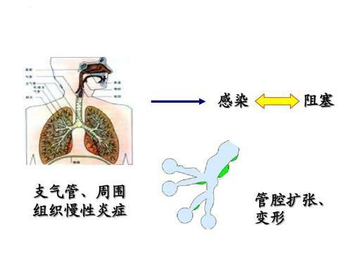 支气管扩张的体位引流如何做,支气管扩张体位引流