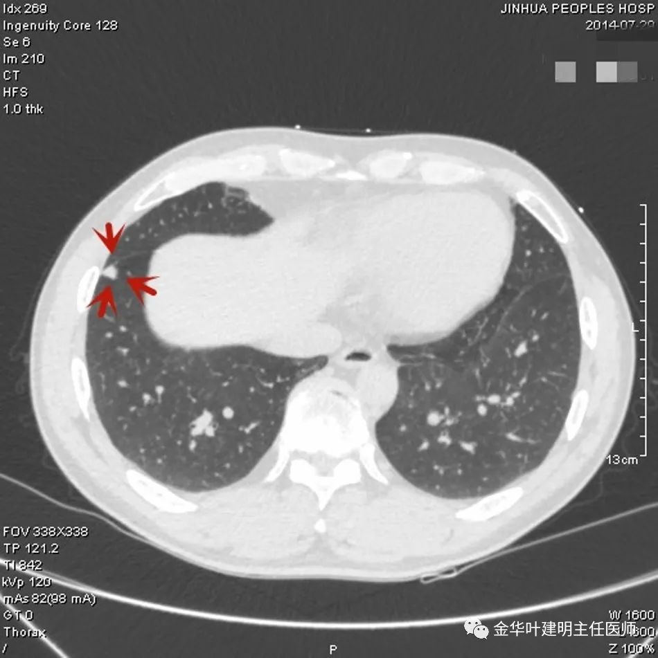 叶建明谈实性结节,叶建明肺实性良性结节会变癌症吗