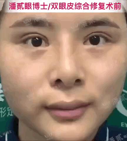 高难度修复双眼皮宽改窄恢复期,高难度双眼皮修复案例