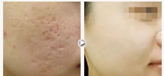 非剥落式点阵激光治疗痘坑,多浅的凹坑可以用点阵激光