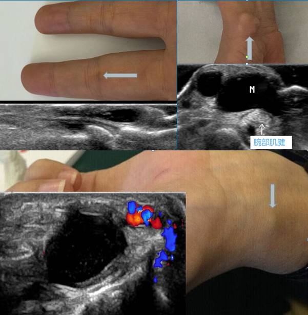手腕出现小疙瘩越来越大,手腕突然长了一个小骨