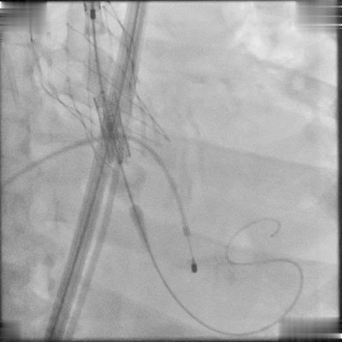 BAV遭遇心脏突然停跳，Sapien3快速植入挽救患者生命