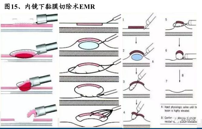 nccn指南胃癌的治疗方案,csco胃癌诊疗指南2023