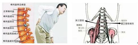 治腰痛离不了镇痛，中西镇痛药安全性大比拼