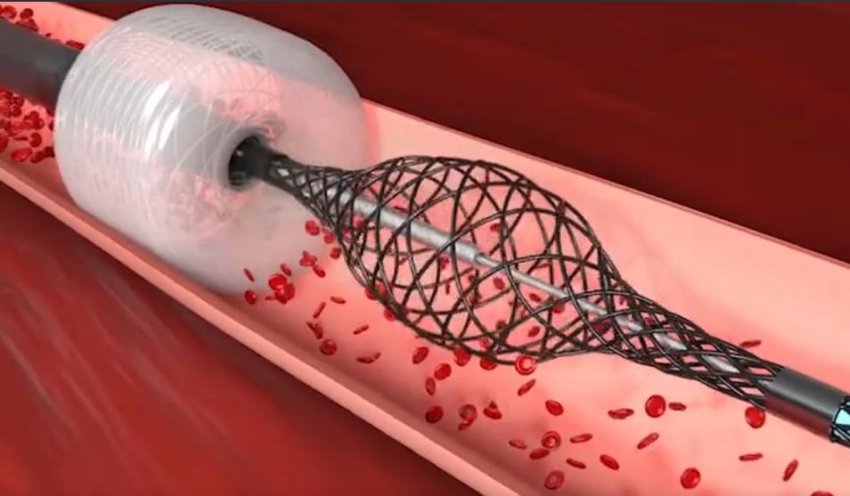 真空取栓装置,仅需3分钟,彻底解决血栓危害?药师带你看真相