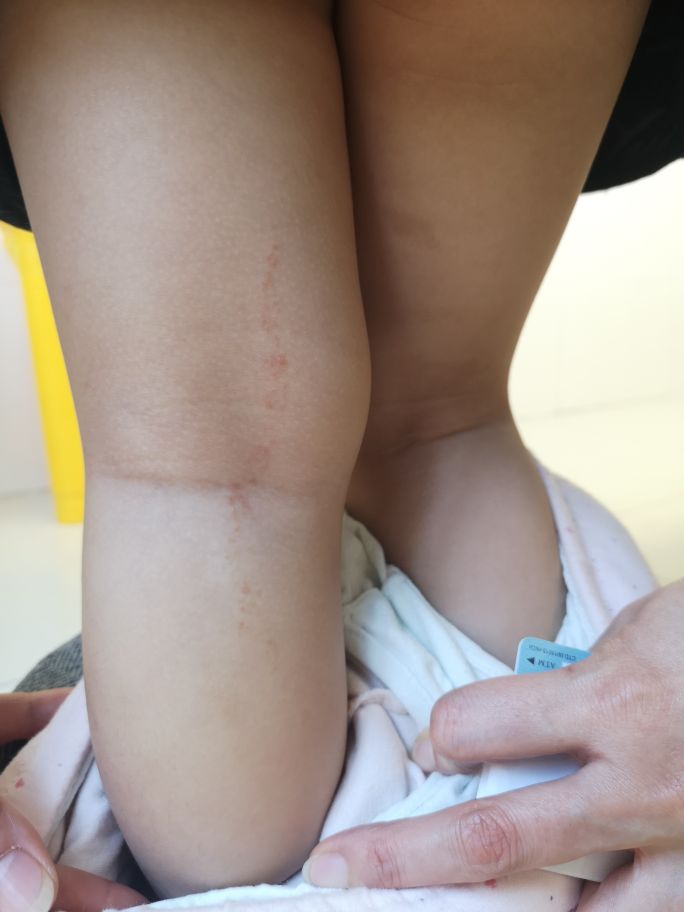 长成圆圈形状是癣还是湿疹,线状苔藓是什么原因造成的