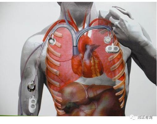 静脉输液港植入是治疗什么病的,静脉输液港植入术