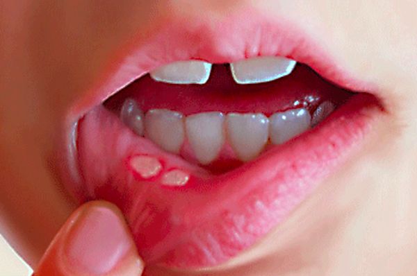 溃疡会很疼吗,口腔溃疡痛也就只有自己忍受