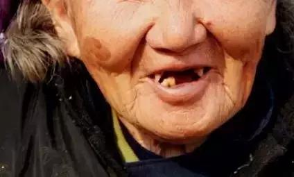 缺失牙公益广告韩国,缺失牙修复的视频