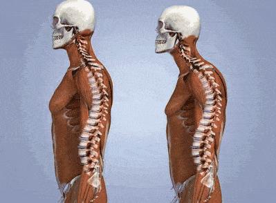 治疗骨盆前倾引起腰痛的锻炼方法,骨盆前倾腰疼纠正最快的方法