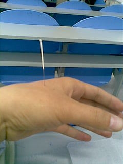 论述合谷穴的主治及操作方法,合谷刺法心得体会